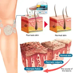 𝐎𝐲𝐢𝐤𝐞𝐲™ Hyaluronic Acid Psoriasis Treatment Cream