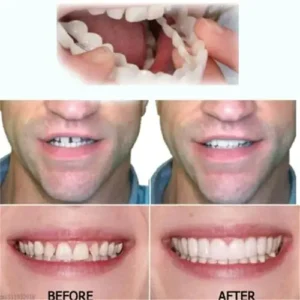 DIYSTAR™ Adjustable Snap-On Dentures