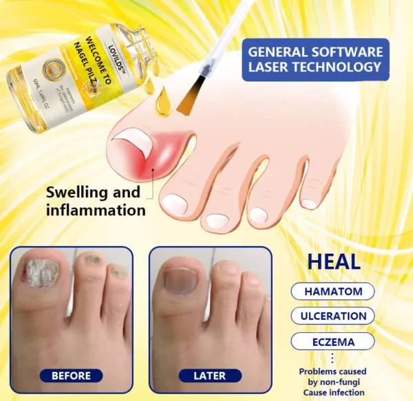 LOVILDS™Wasp Toxin Gray Nail Treatment