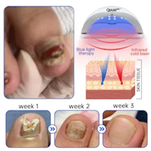 QIAWI™ PureNail Fungus Laser Device