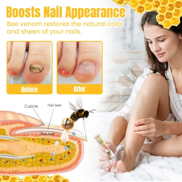 Ceoerty™ FungiGone Bee Venom Nail Cream